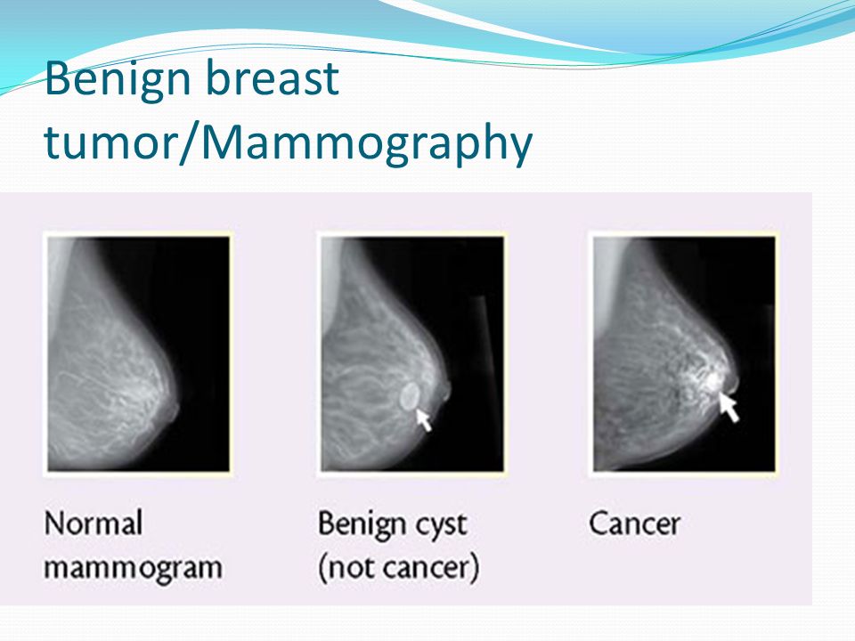 benign tumors breast